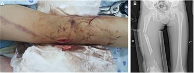 Successful reimplantation of extruded bone segment in lower limb open fractures: case report and literature review